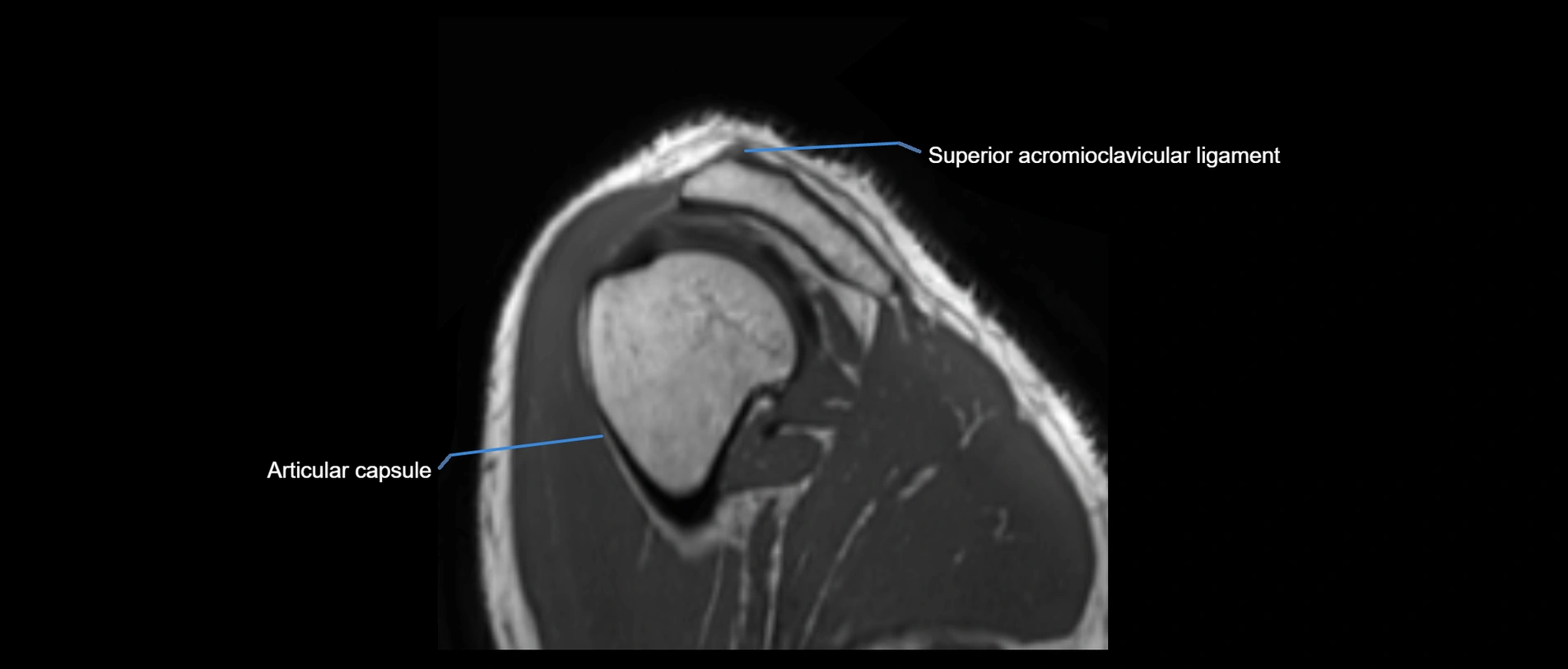 shoulder ligaments sagittal  cross sectional anatomy 3T MRI AI enhanced radiology image -img-00001-00048.webp